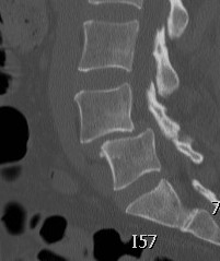 Degenerative Spondylolithesis CT 2